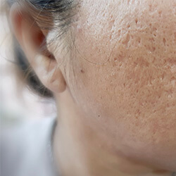 Acne Scarring | Javivo Aesthetic Clinic in Manchester