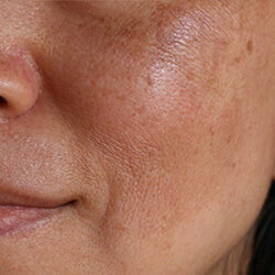 Hyperpigmentation | Javivo Aesthetic Clinic in Manchester