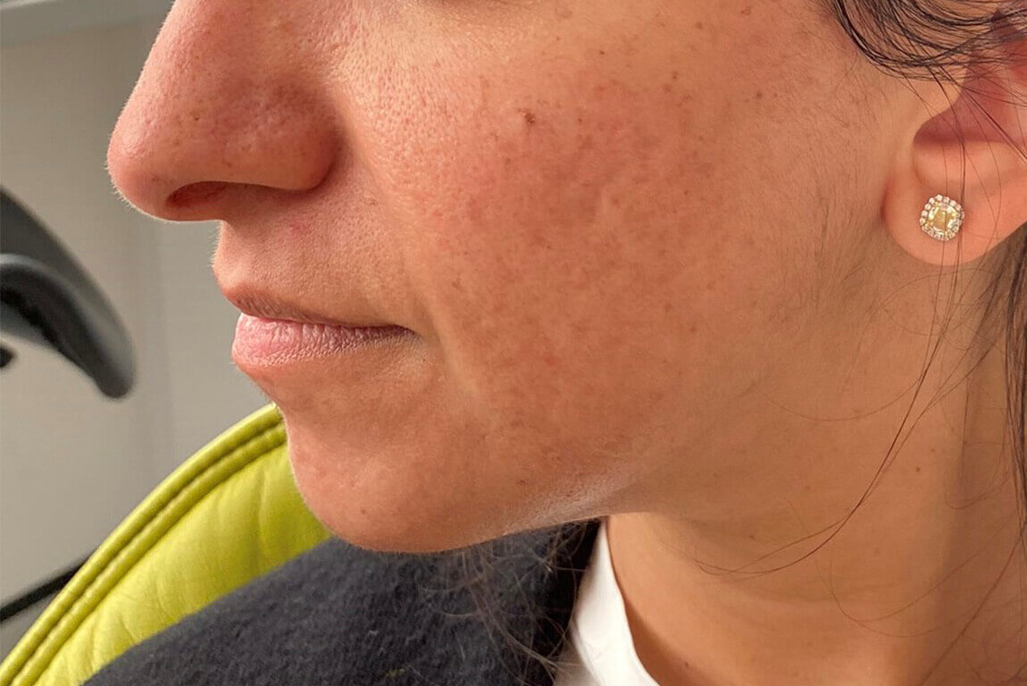 After | Javivo Aesthetic Clinic in Manchester