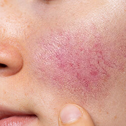 Rosacea | Javivo Aesthetic Clinic in Manchester