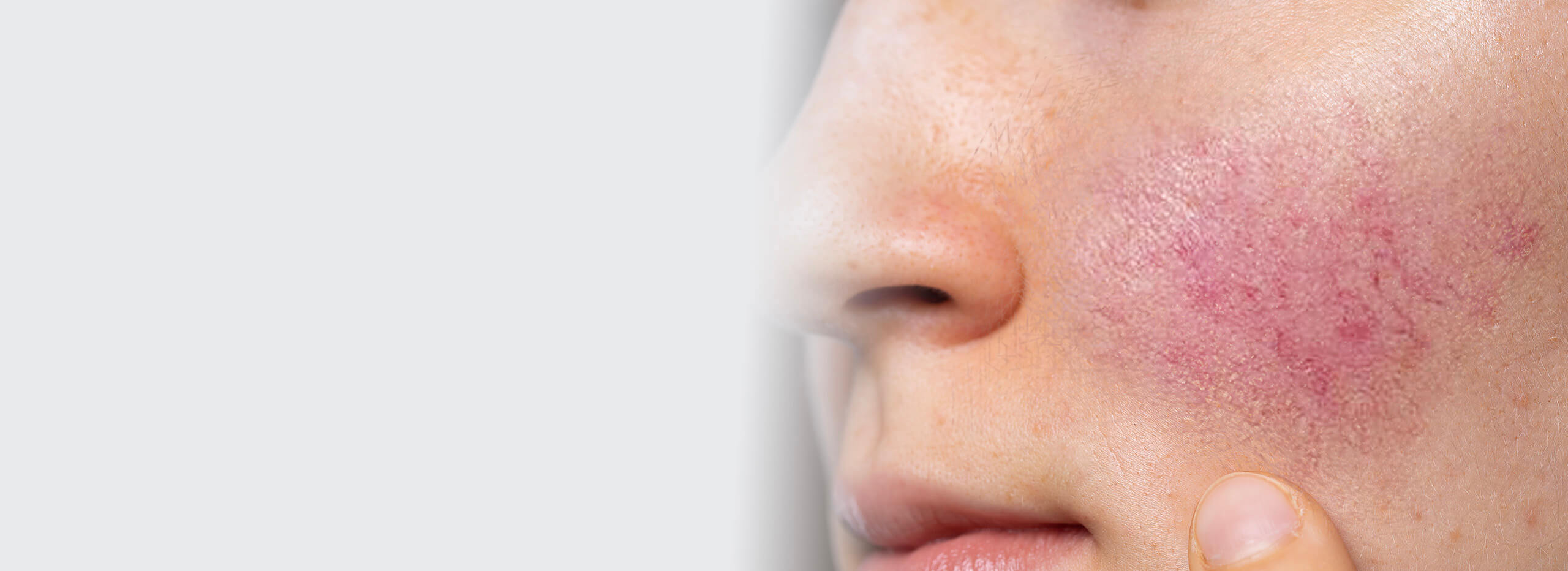 Rosacea | Javivo Aesthetic Clinic in Manchester