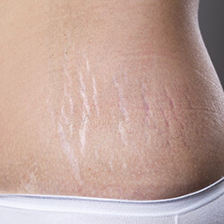 Stretch Marks | Javivo Aesthetic Clinic in Manchester