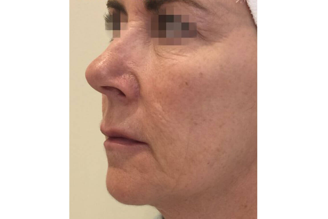 After | Javivo Aesthetic Clinic in Manchester