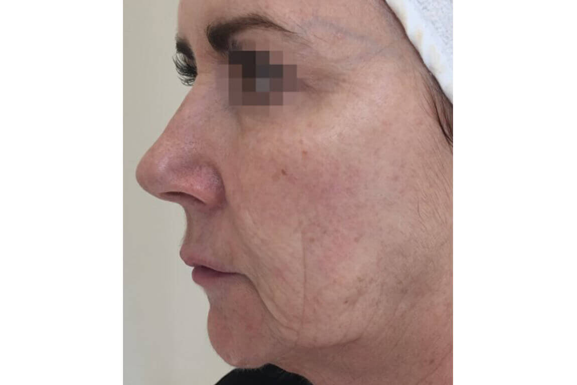 Before | Javivo Aesthetic Clinic in Manchester