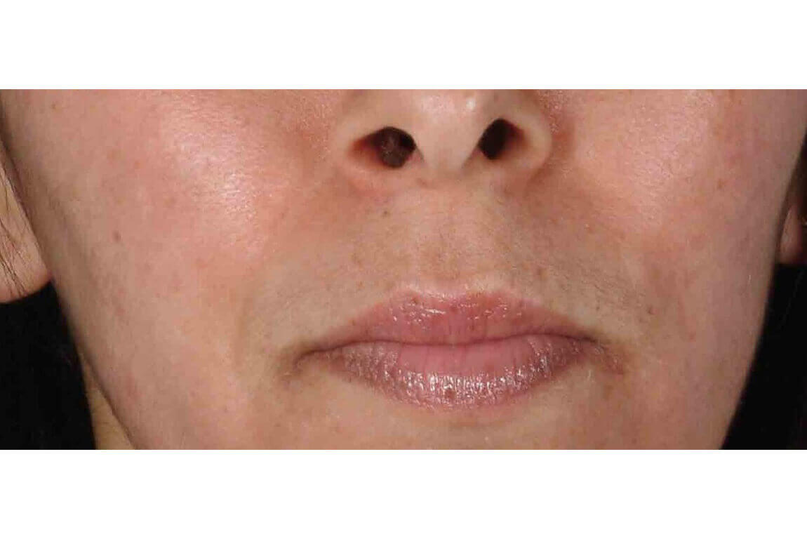 After | Javivo Aesthetic Clinic in Manchester