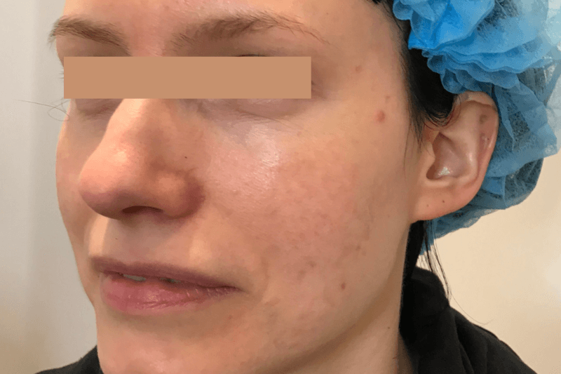 After | Javivo Aesthetic Clinic in Manchester