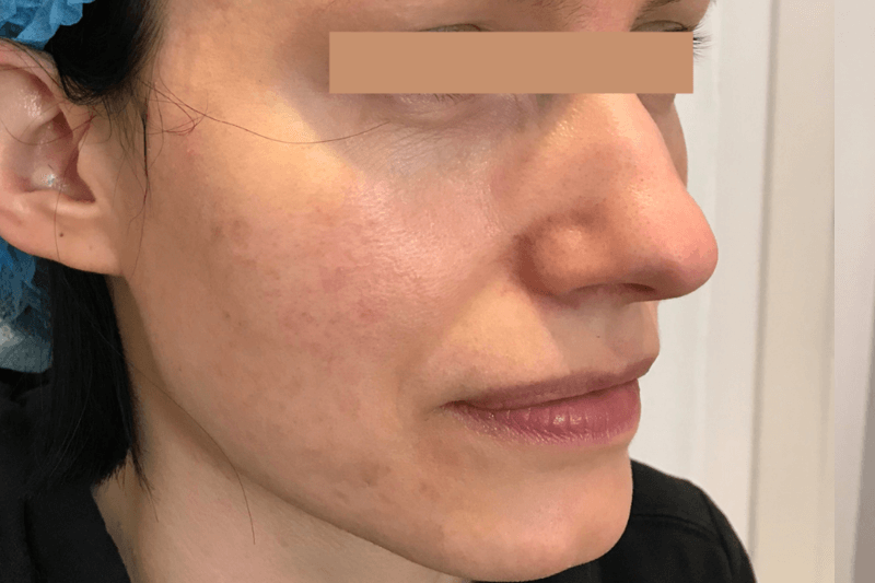 After | Javivo Aesthetic Clinic in Manchester