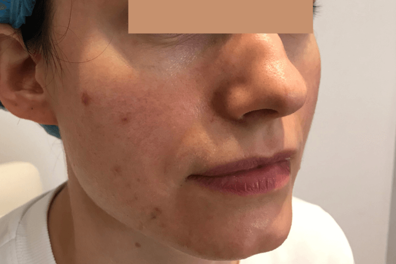 Before | Javivo Aesthetic Clinic in Manchester
