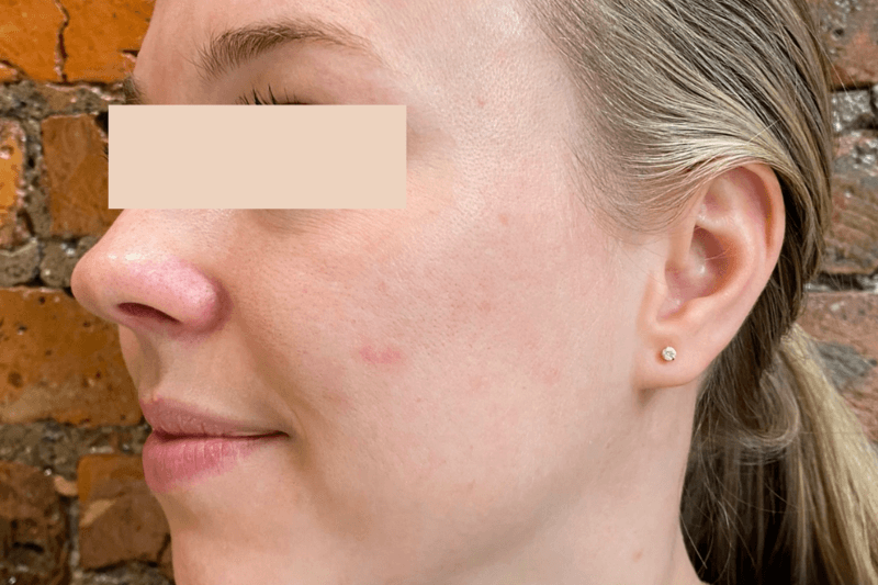 After | Javivo Aesthetic Clinic in Manchester