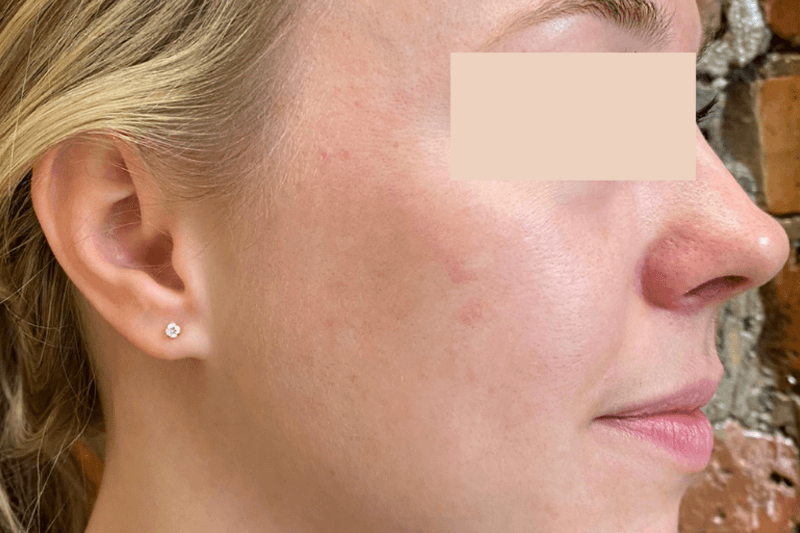 After | Javivo Aesthetic Clinic in Manchester