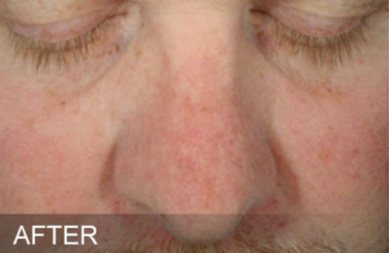 After | Javivo Aesthetic Clinic in Manchester